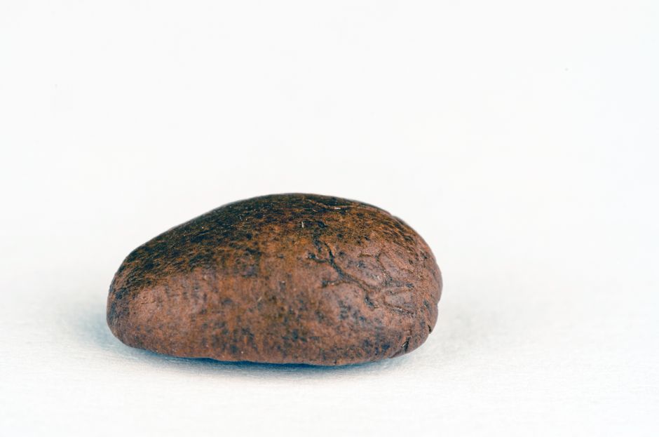 Gallstones illustration